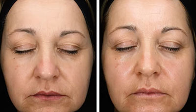 Chemical-Peels-before-after-aging