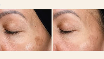 Chemical-Peels-before-after-pigmentation