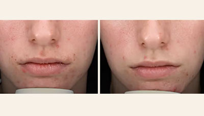 Chemical-Peels-before-after-acne