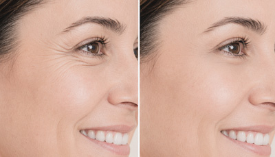 Anti-Wrinkle-Injections-crows-Nayma