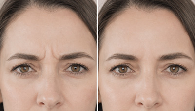 Anti-Wrinkle-Injections-frown-Nayma