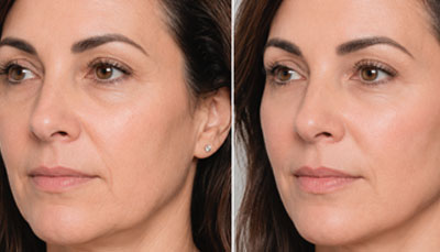 Dermal-Fillers-before-after-Jawline
