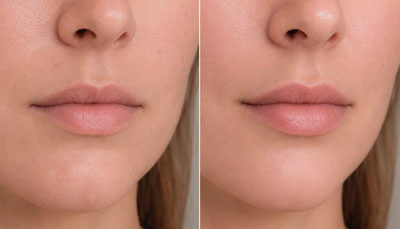 Dermal-Fillers-before-after-lips