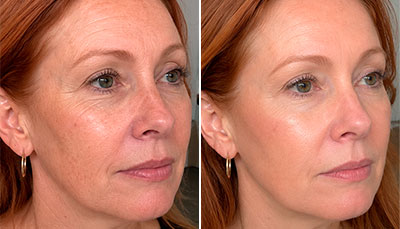Mesotherapy-Fine-lines