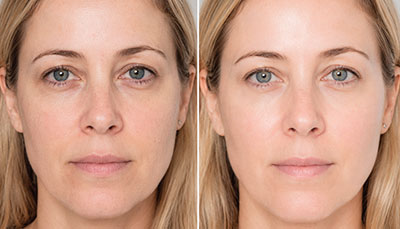 Mesotherapy-Skin-radiance