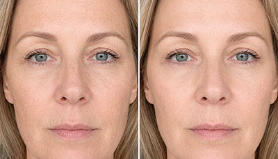 Microneedling-fine-lines
