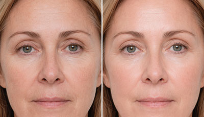 Skin-boosters-skin-texture