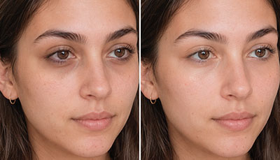 Skin-boosters-under-eyes
