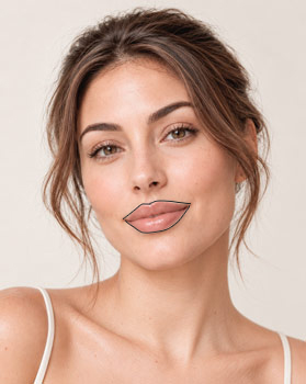 Dermal-Fillers-where-lip
